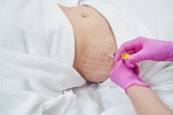 image of fat dissolving injections on love handles to help combat weight gain Shettleston