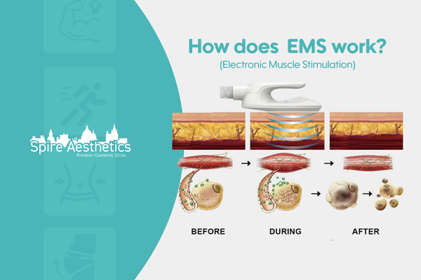 EMS treatment for post pregnancy weight loss treatment Shettleston