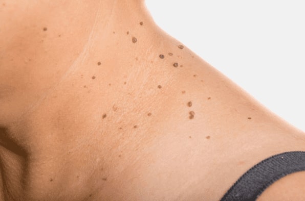 Are you looking for easy skin tag removal Shettleston - then contact Spire today!