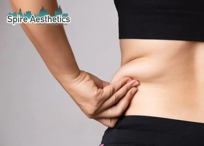 Image of woman pinching fat on their hips Shettleston. Fat Freezing treatment