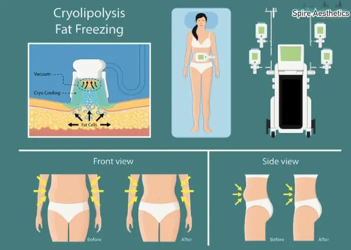Fat freezing treatment Shettleston benefits for competitions to remove stubborn fat deposits.