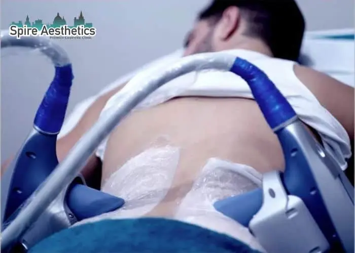 Man having fat freezing treatment done on love handles before a competitions Shettleston to create a sculpted look.