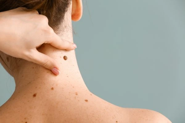 skin blemish removal Shettleston treatment
