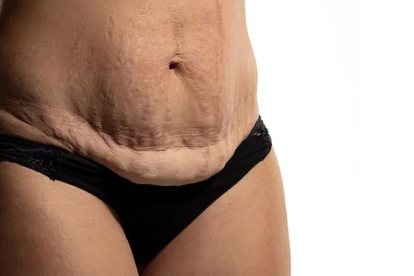 Image of womans stomach after weight loss injections Shettleston showing saggy skin