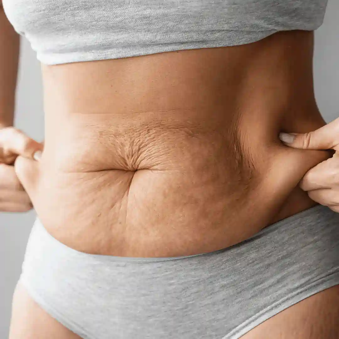 Is It Normal to Have Loose Skin After Pregnancy Shettleston?